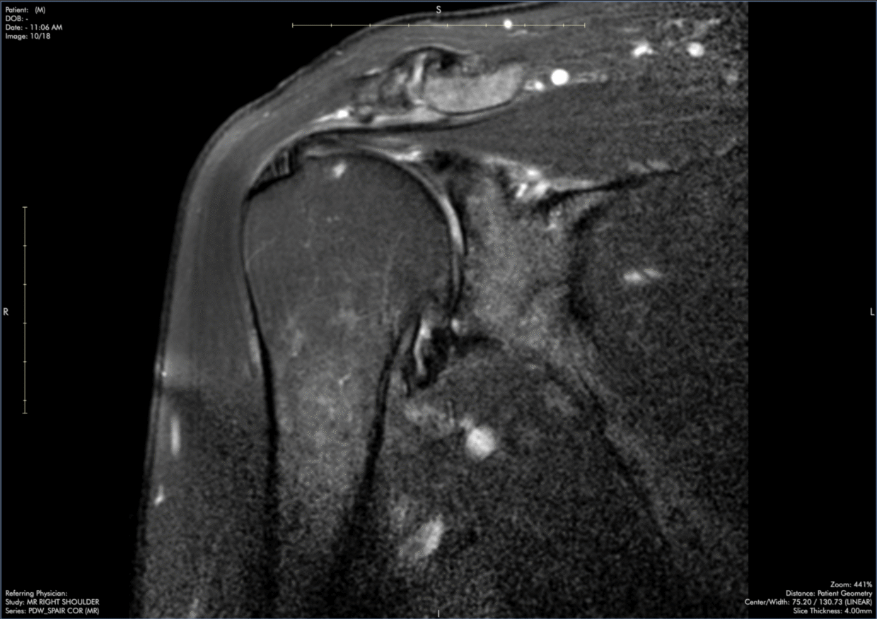 infraspinatus-tendinopathy-msk-shoulder-mri-case-review-with-dr-stephen-pomeranz-3