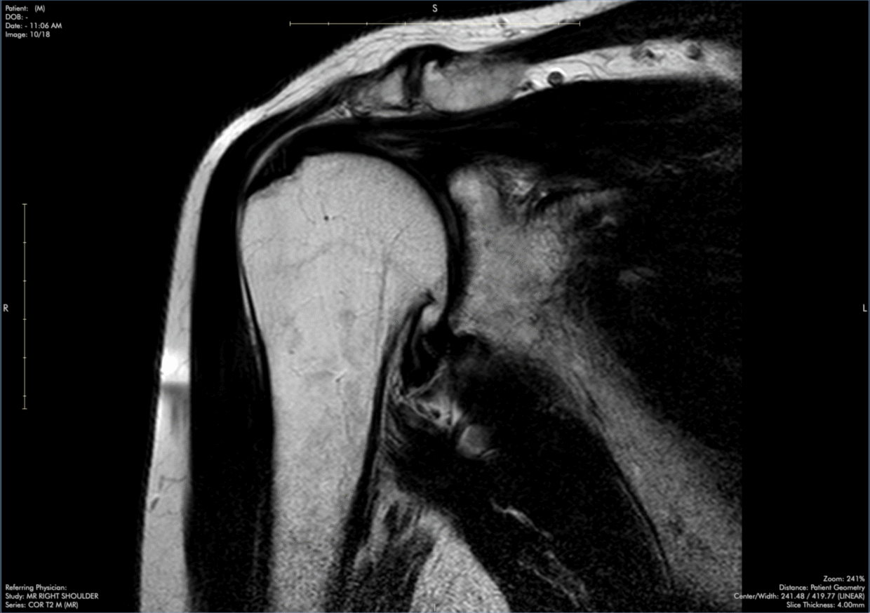 infraspinatus-tendinopathy-msk-shoulder-mri-case-review-with-dr-stephen-pomeranz-4