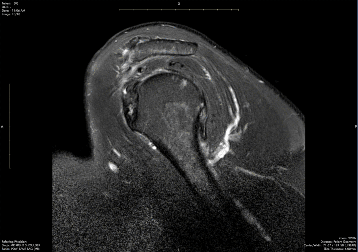 infraspinatus-tendinopathy-msk-shoulder-mri-case-review-with-dr-stephen-pomeranz-5