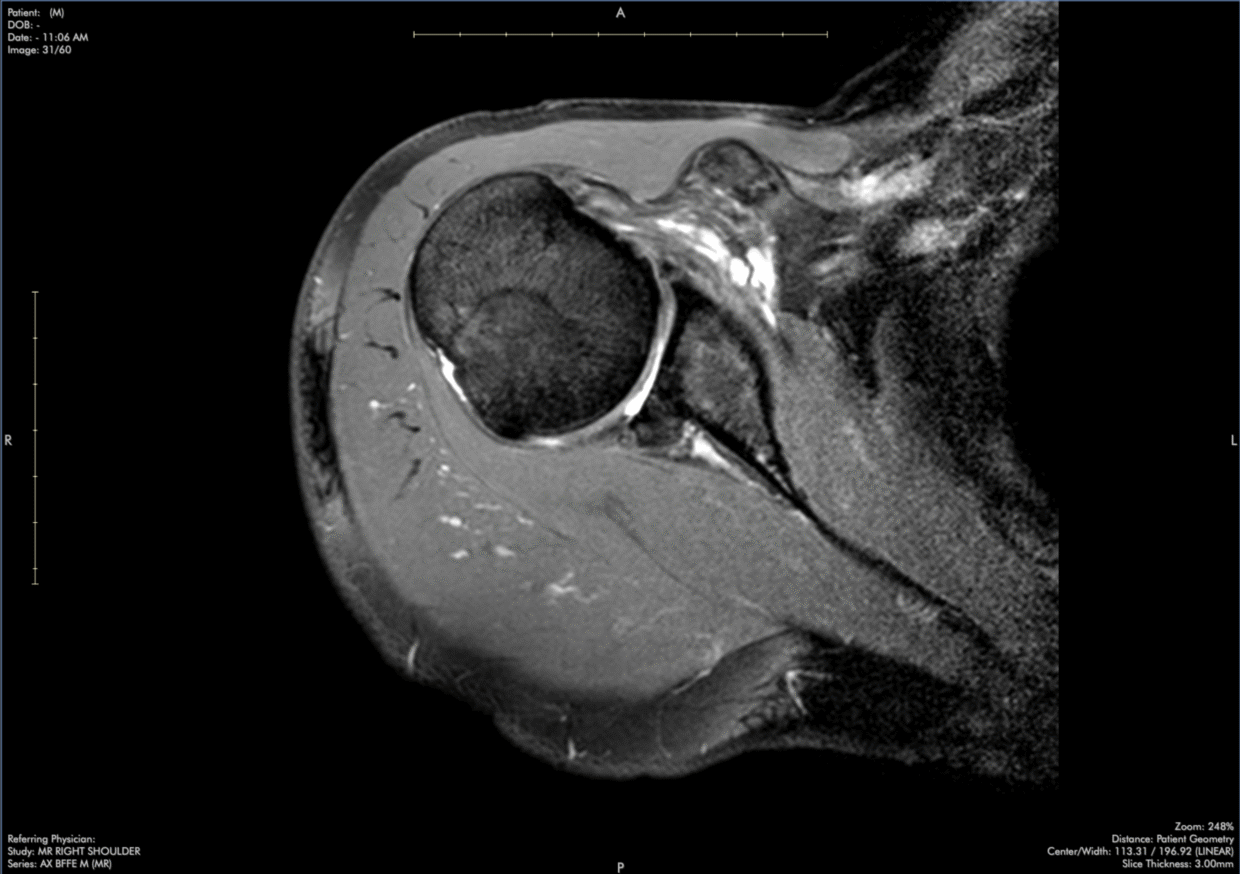infraspinatus-tendinopathy-msk-shoulder-mri-case-review-with-dr-stephen-pomeranz-6