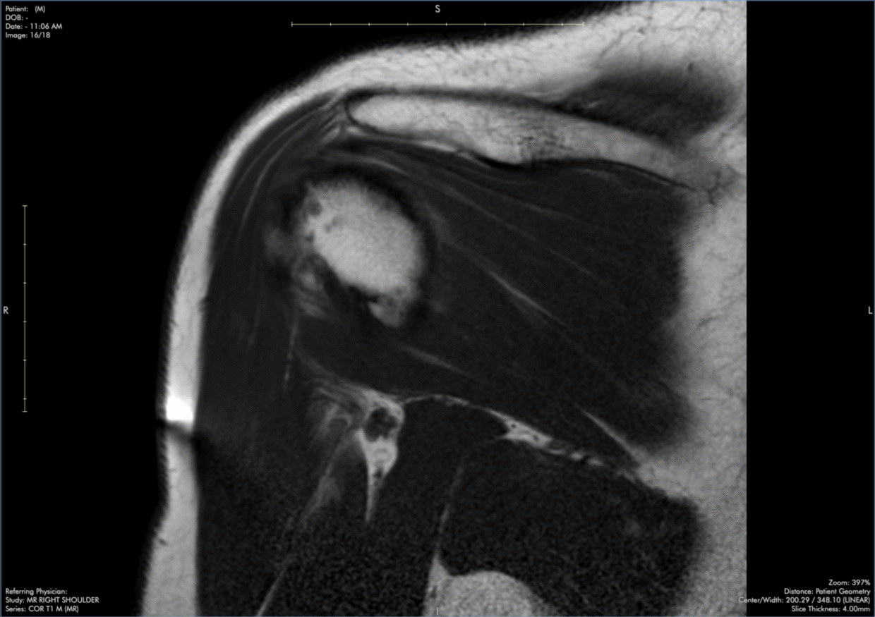 infraspinatus-tendinopathy-msk-shoulder-mri-case-review-with-dr-stephen-pomeranz-7