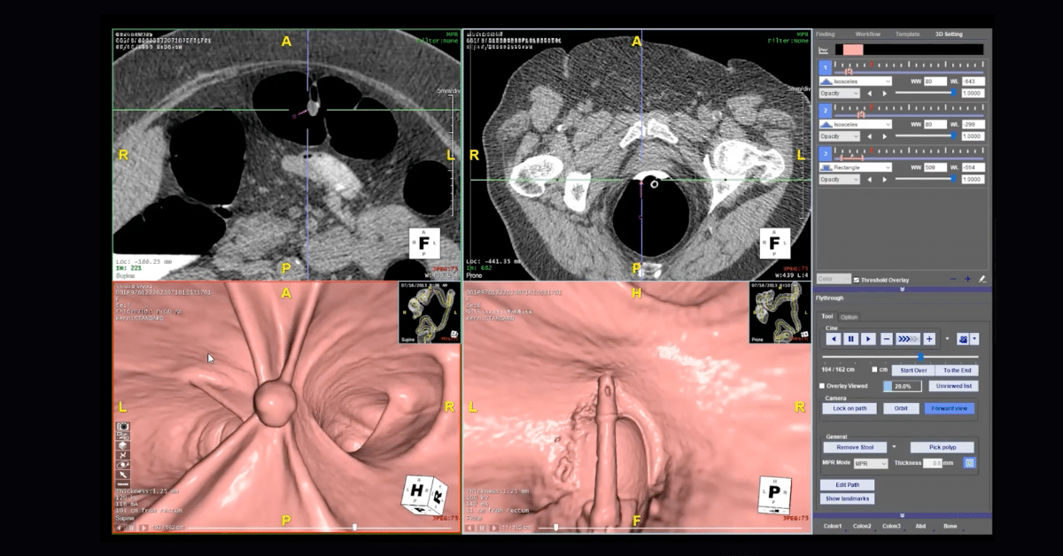 CT Colonography