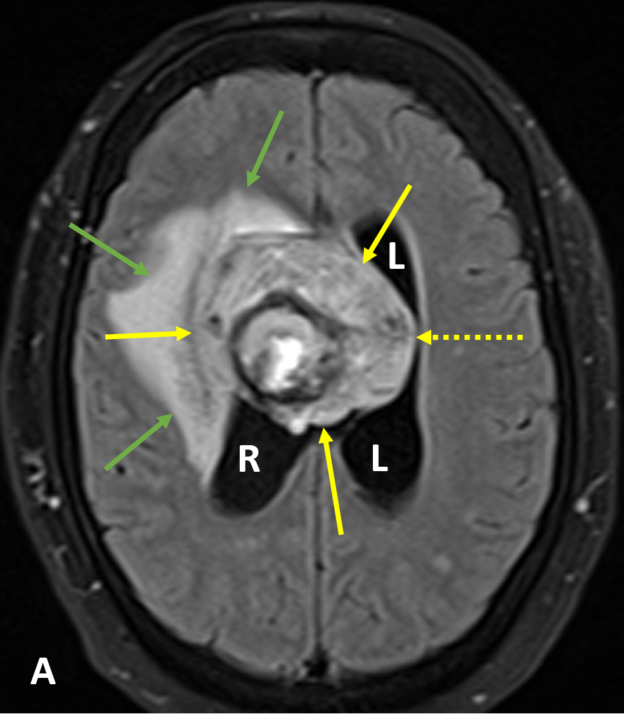 Intraventricular hemorrhage (IVH) of undetermined cause in a 65-year-old woman. A. Axial FLAIR image shows a 5 cm heterogeneous mass (solid yellow arrows) within the right lateral ventricle (R), compressing the left lateral ventricle (L) and causing midline shift (dashed arrow). There is extensive fronto-parietal lobe and periventricular white matter hyperintense edema (green arrows). The lateral ventricles are enlarged and the posterior horns are rounded, consistent with hydrocephalus.