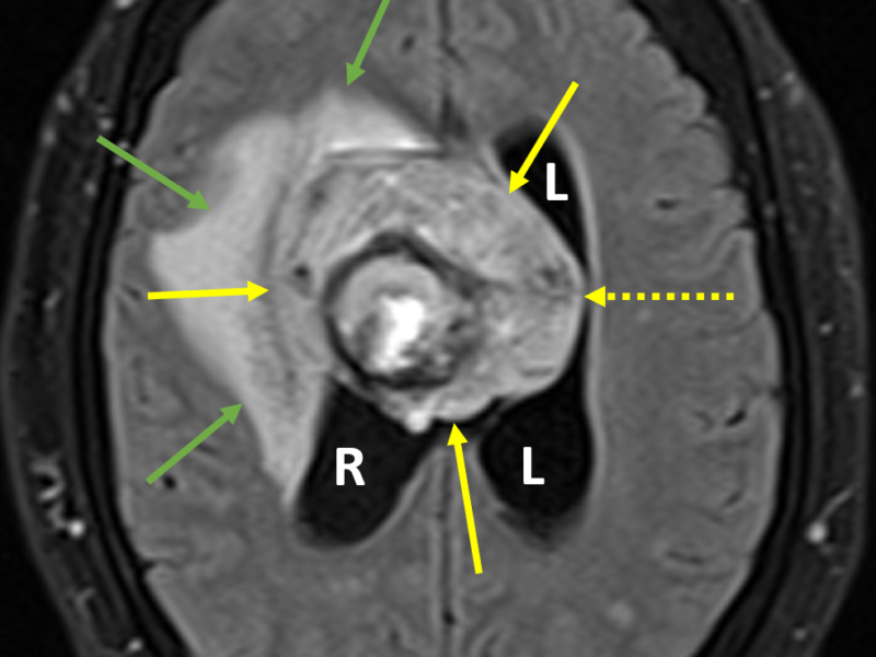 Intraventricular hemorrhage (IVH) of undetermined cause in a 65-year-old woman. A. Axial FLAIR image shows a 5 cm heterogeneous mass (solid yellow arrows) within the right lateral ventricle (R), compressing the left lateral ventricle (L) and causing midline shift (dashed arrow). There is extensive fronto-parietal lobe and periventricular white matter hyperintense edema (green arrows). The lateral ventricles are enlarged and the posterior horns are rounded, consistent with hydrocephalus.