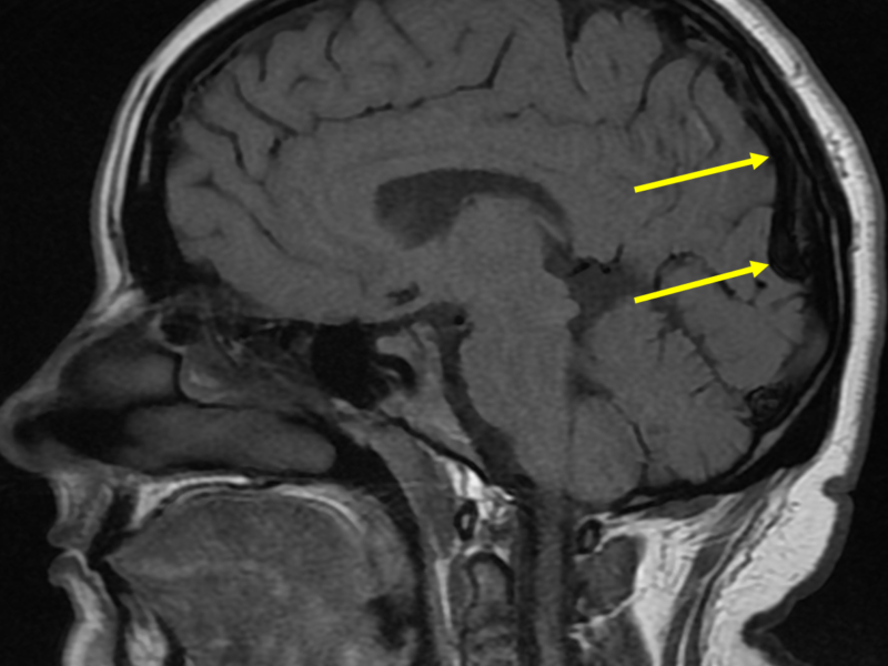 B. Sagittal T1 image at a level medial to (A) shows a large low signal tubular structure (arrows), representing a large draining vein, extending superiorly to communicate with the sagittal sinus.