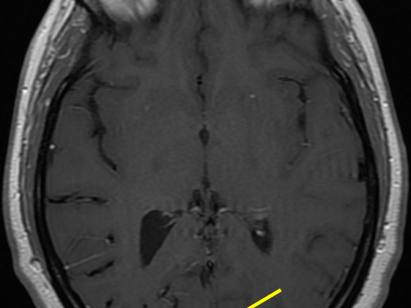 C. Axial T1 image shows a large draining vein (arrow).