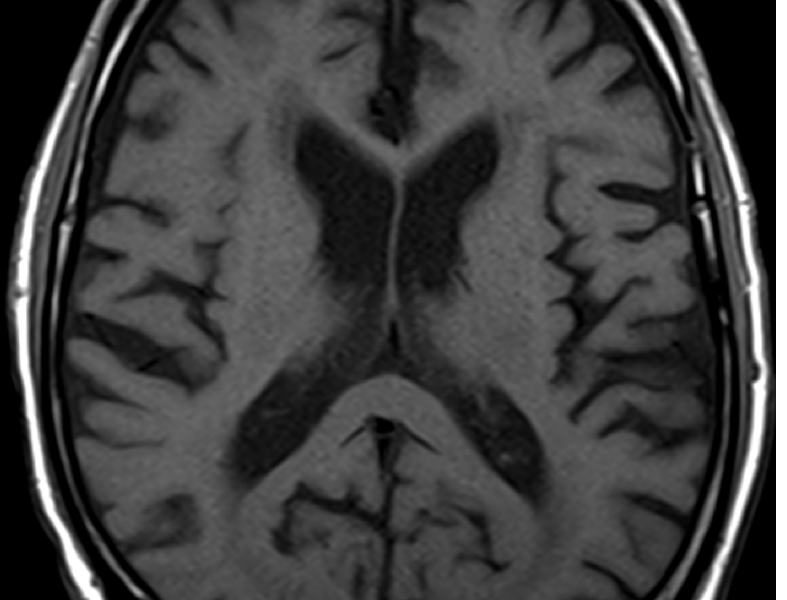 Coronal T2 MRI (A) of an 85-year-old man with dementia shows marked atrophy of the medial temporal lobes, especially the hippocampi, with greater involvement of the right hippocampus (arrow) compared with the left. Axial T1 image at the level of the lateral ventricles (B) shows a prominent ventricular system and cortical sulci consistent with diffuse cortical volume loss without hydrocephalus. Axial T1 image (C) inferior to (B) shows marked atrophy of the temporal lobes (T) and normal flow voids in the anterior communicating arteries (long arrows) and middle cerebral arteries (short arrows).