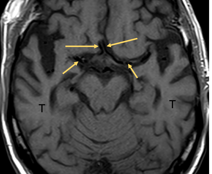 Coronal T2 MRI (A) of an 85-year-old man with dementia shows marked atrophy of the medial temporal lobes, especially the hippocampi, with greater involvement of the right hippocampus (arrow) compared with the left. Axial T1 image at the level of the lateral ventricles (B) shows a prominent ventricular system and cortical sulci consistent with diffuse cortical volume loss without hydrocephalus. Axial T1 image (C) inferior to (B) shows marked atrophy of the temporal lobes (T) and normal flow voids in the anterior communicating arteries (long arrows) and middle cerebral arteries (short arrows).