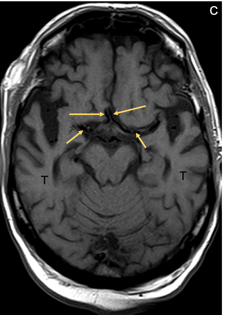Alzheimer Disease (AD) - MRI Online