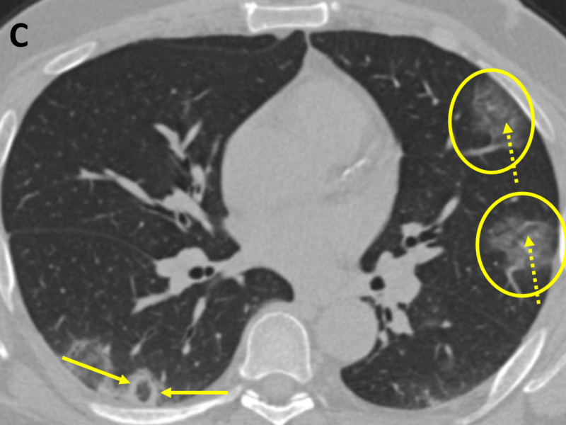 C. CT scan of the lung bases shows peripheral, rounded areas of GGO (circles) in the left upper lobe. Linear and small round lucencies within the areas of GGO represent air bronchograms (dashed arrows) that should not be mistaken for areas of lung necrosis. Another area of GGO with surrounding consolidation (reverse halo/atoll sign) is seen in the right lower lobe (solid arrows).