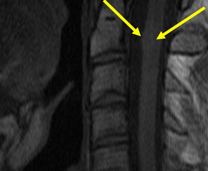 Cavernous malformation in a 25-year-old man with neck pain and bilateral hand stiffness and numbness. A. Sagittal T1 FSE image shows a subtle 1 cm heterogeneously isointense, mildly expansile intramedullary mass (arrows) just superior to the C2-3 disc space.