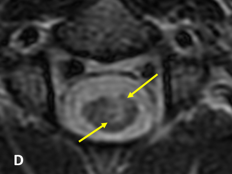 D. Axial T2 FRFSE image shows the heterogeneous mass (arrows) extending to the subpial surface to the left of midline.