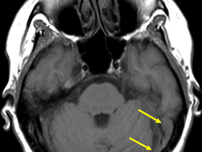 Cerebral venous thrombosis in a 53-year-old woman with dysautonomia, benign positional vertigo of central origin, ataxia, T/L-spine neuritis/radiculitis, and family history of multiple sclerosis. A. Axial T1 SE MR image shows isointense (to brain) signal within the left transverse and sigmoid sinuses (arrows).