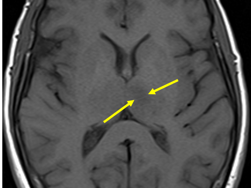Acute cerebral infarction in a 65-year-old woman with distorted vision and memory issues. A. Axial T1 MR image shows abnormal low signal within the left thalamus (arrows).