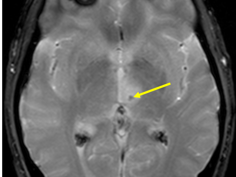 C. Axial T2 gradient echo (GRE) image at the same level as (A) shows a small area of low signal (arrow) within the affected thalamus, consistent with hemorrhage. Thalamic location of infarction is consistent with the history of visual distortion and memory impairment. Thalamic infarcts are most commonly due to disruption of flow in the posterior cerebral arterial circulation.