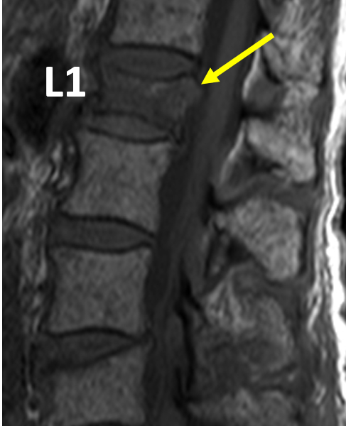 Multiple myeloma in a 79-year-old woman with worsening low back pain and radiographic changes suspicious for L1 compression fracture. A. Sagittal T1-weighted MR image shows hypointense marrow infiltration with a heterogeneous “salt and pepper” pattern throughout the visualized thoracic and lumbar spine. Greater than 50% compression of L1 is new compared with prior exam. The L1 bone marrow is hypointense, consistent with edema and acute fracture. There is retropulsion of the vertebral body fragments (arrow) and thecal sac abutment but no thecal sac effacement or spinal cord compression. Compression of L4 is unchanged compared with prior exam.