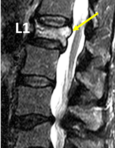 C. Sagittal STIR image shows hyperintense L1 bone marrow signal, consistent with edema and acute fracture, and retropulsion of fracture fragments (arrow).