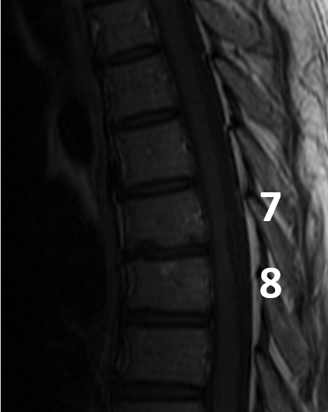 B. Sagittal T1 image with gadolinium contrast shows no enhancement of the cord lesions, consistent with inactive disease.