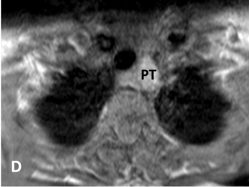 D. Axial T1 TSE image with contrast shows avid enhancement of the adenoma (PT).