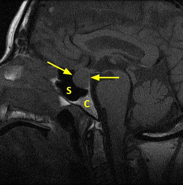 (A) Pituitary macroadenoma in a 64-year-old woman with decreased peripheral vision. A. Sagittal T1 SE 3mm slice MR image shows the sella turcica expanded by a 2 cm sellar and suprasellar mass (arrows). There is no retrosellar extension. The sphenoid sinus (S) is patent. There is no extension inferiorly to involve the clivus (C).