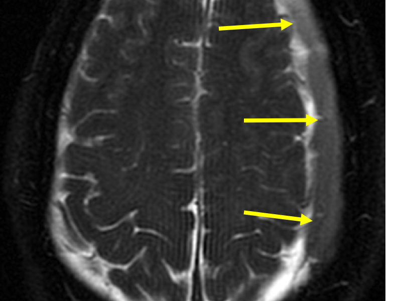 Chronic SDH in a 64-yea-old man with a headache. T1-weighted (A) and T2-weighted (B) axial MRI images show an elongated, extra axial, frontoparietal, crescentic fluid collection (arrows) that is hyperintense to brain.