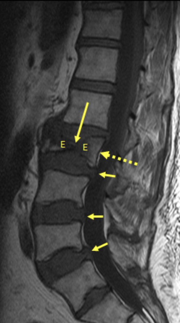 (A) Benign acute vertebral compression fracture (VCF) in a 75-year-old man with low back pain for 5 months. A. Sagittal weighted MRI of the lumbar spine shows caudal displacement of the superior end plate of L3 (long solid arrow) with approximately 60% loss of vertebral body height and normal morphology of the posterior vertebral body cortex (dashed arrow). There is low signal within the marrow of L3 (E) consistent with edema and acute fracture. There is also posterior disc bulging at several levels (short arrows).