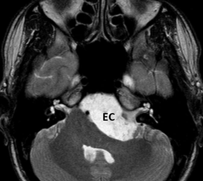 B. Axial T2 image shows the cyst (EC) to be of heterogeneous high signal.