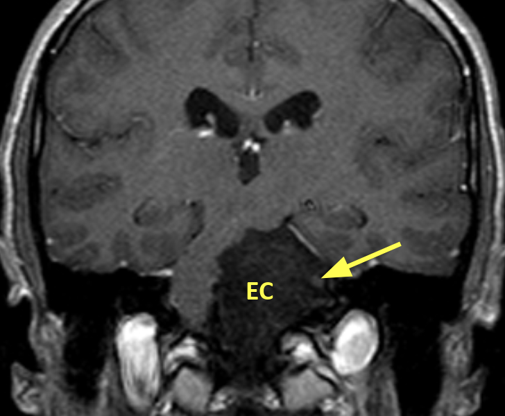 E. Coronal T1 image post contrast shows The left fifth nerve complex (arrow) encased by the cyst (EC) laterally.