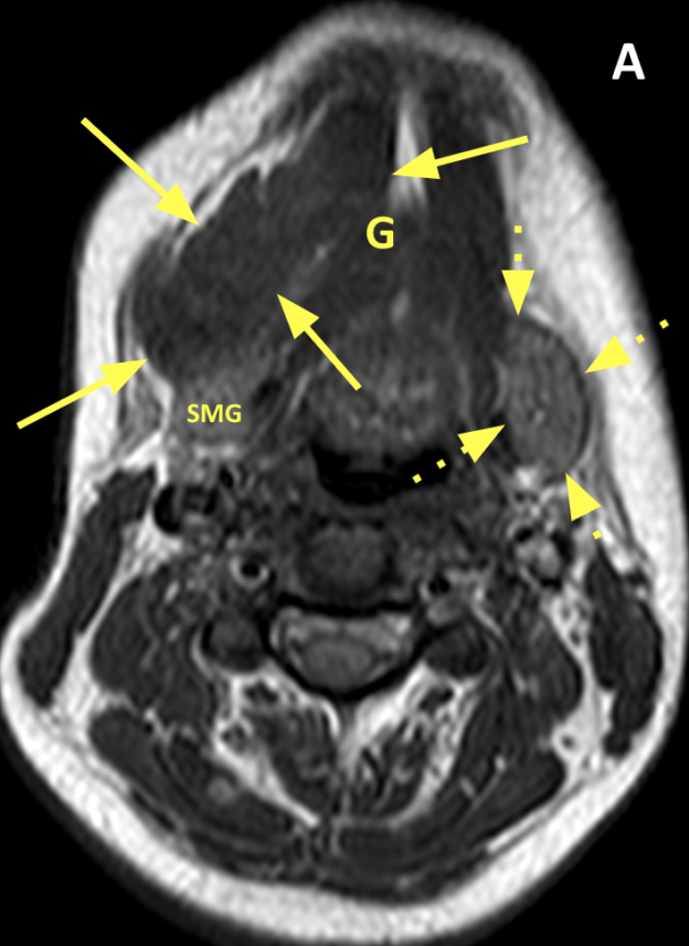 Recurrent ranula in a 24-year-old woman post injection therapy and surgical excision. A. Axial T1 MR image shows a 6 cm well-circumscribed, thin-walled, low signal mass (solid arrows) displacing the genioglossus muscle medially (G) and the right submandibular gland posteriorly (SMG). The left submandibular gland is normal in appearance (dashed arrows).