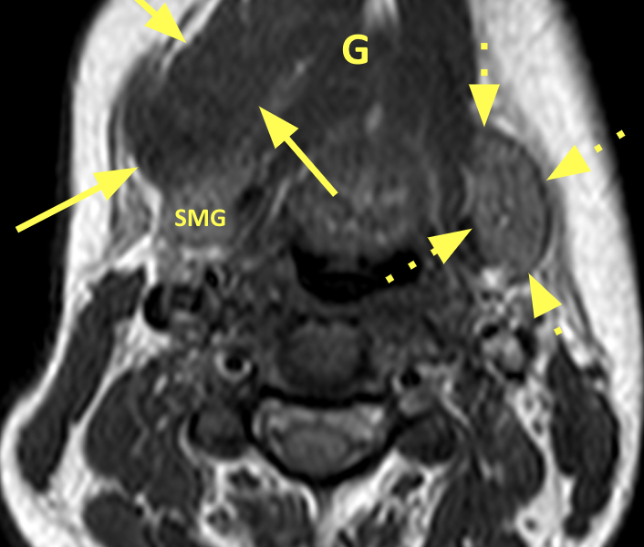 Recurrent ranula in a 24-year-old woman post injection therapy and surgical excision. A. Axial T1 MR image shows a 6 cm well-circumscribed, thin-walled, low signal mass (solid arrows) displacing the genioglossus muscle medially (G) and the right submandibular gland posteriorly (SMG). The left submandibular gland is normal in appearance (dashed arrows).