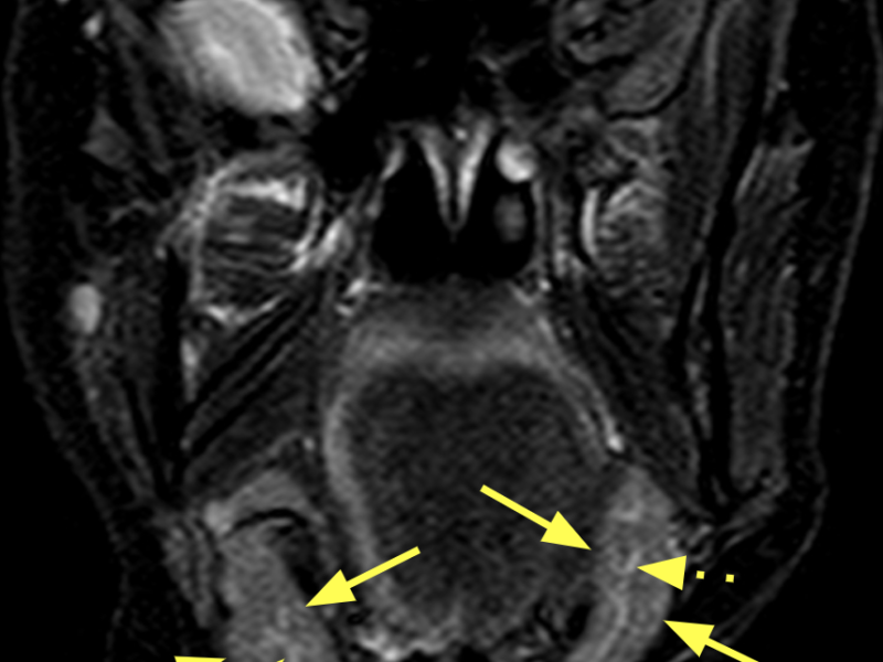 B. Coronal STIR long TE image shows the posterior submandibular glands (solid arrows) to be normal in appearance except for some inferior displacement on the right. The high signal internal ductal system is seen (dashed arrows).