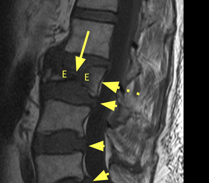 Vertebral Compression Fracture Vcf Mri Online