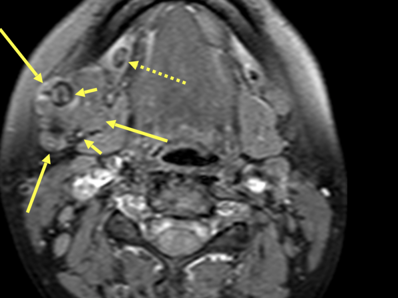 Sialolithiasis of right submandibular gland in a 14-year-old girl. A. Axial T1 TSE MR image shows a diffusely enlarged right submandibular gland (large arrows) with areas of heterogeneous signal (short arrows) consistent with calcifications. There are also calcifications in the expected course of Wharton’s duct (dashed arrow). There is no surrounding edema or fluid collection, suggesting a chronic process. The left gland and duct are also affected, although less so than the right.