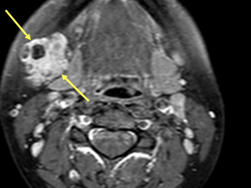 B. Axial T1 TSE image with contrast shows heterogeneous enhancement of the right submandibular gland (arrows).