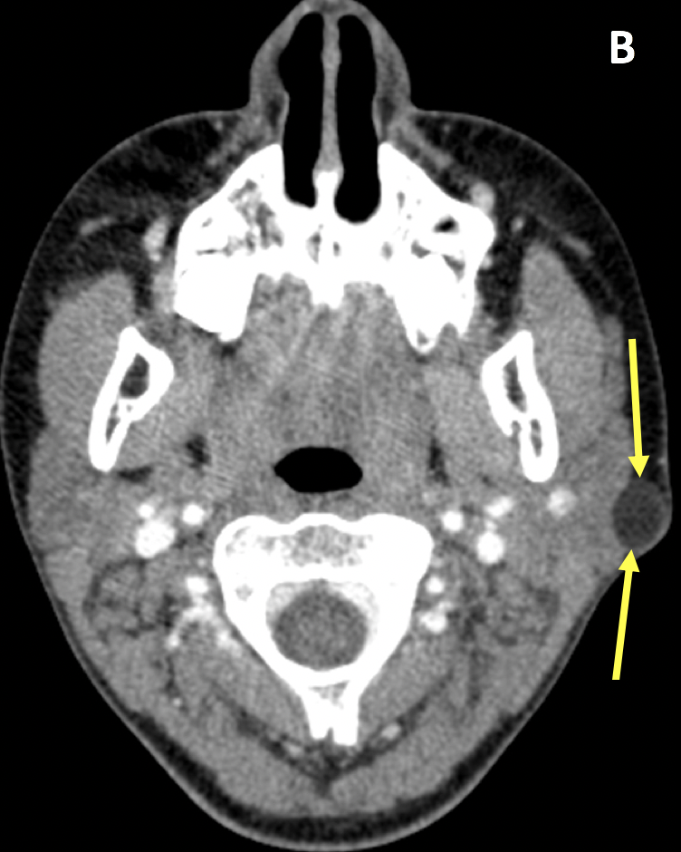 Dermoid cyst - MRI Online