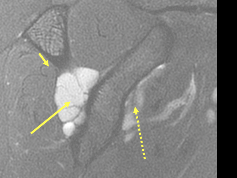 D. Sagittal T2 fat saturated image post direct arthrogram shows a large hyperintense multiloculated paralabral cyst in the spinoglenoid notch (long arrow) and intra-articular contrast within the subscapular recess (dotted arrow). There are no signs of denervation edema or fatty atrophy of the infraspinatus muscle (short arrow).