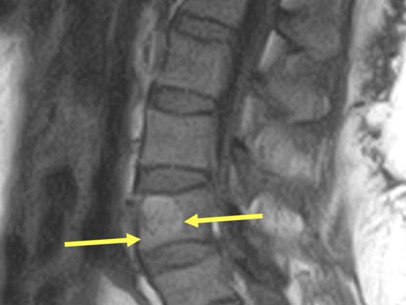 Vertebral hemangioma in a 51-year-old woman with a 5-month history of low back pain. A. Sagittal T1 SE MR image shows a circumscribed area of high signal (arrows) in the anterior L4 vertebral body. This was an incidental finding and unrelated to the patient’s symptoms. The high signal is related to fat in the lesion.