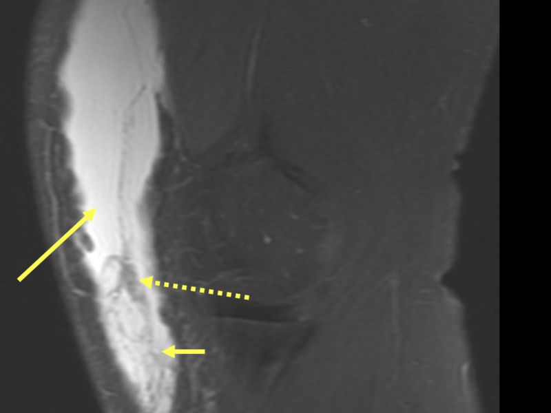 C. Sagittal PD fat saturated of the left knee shows a large T2 hyperintense collection (long solid arrow) in the deep subcutaneous tissues with dependently positioned fibrinous/hemorrhagic debris (short arrow) and part of a fat globule which has suppressed in signal on fat saturation (dotted arrow).