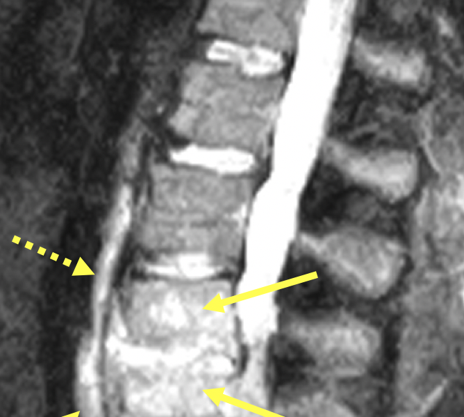 B. Sagittal STIR (fat suppressed) image at the same level as (A) shows hyperintense signal within the L3 and L4 vertebral bodies (arrows) and destruction of the inferior L3 and superior L4 endplates. High signal in the prevertebral soft tissues (dashed arrows) is consistent with an inflammatory fluid collection. No walled-off abscess is seen.