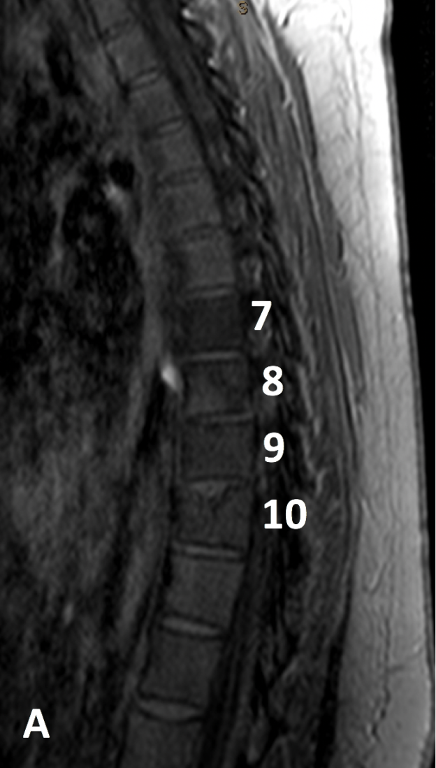 Hodgkin disease in an 18-year-old woman post chemotherapy. A. Sagittal T1 turbo spin echo (TSE) MR image shows abnormal low signal within vertebral bodies T7-10. There is no vertebral body collapse.