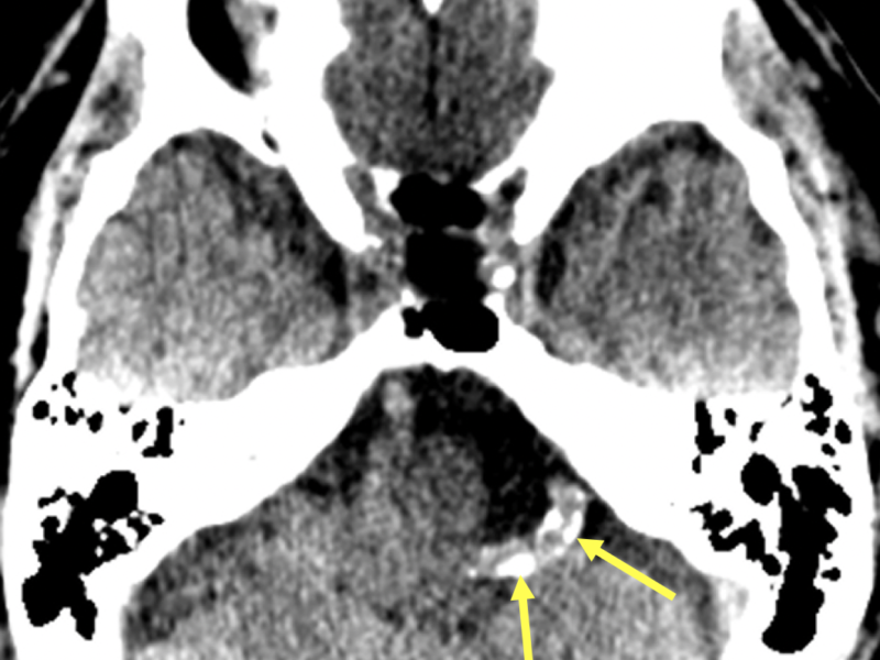 C. Axial CT at a level superior to (B) shows a densely calcified left vertebral artery (arrows).