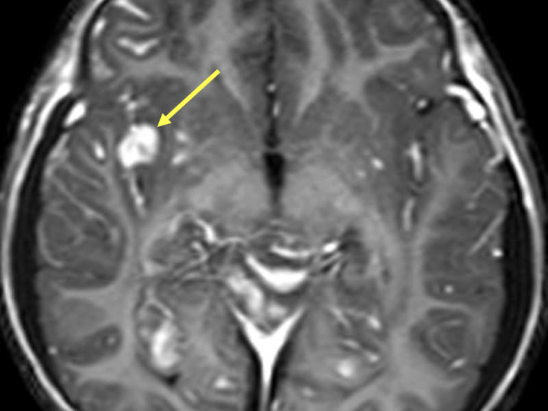 D. Axial T1 image post-contrast at a level superior to (A) and (B) shows diffuse leptomeningeal enhancement, most pronounced at the right Sylvian fissure (arrow).