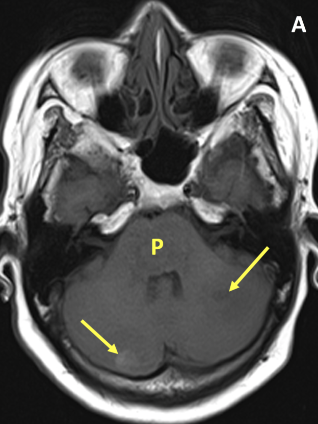 Hemorrhagic and non-hemorrhagic intraparenchymal brain metastases in a 53-year-old woman with dysphagia, altered mental status, and a history of lung cancer. A. Axial T1-weighted MR image shows heterogeneous signal in the pons (P) but no discrete lesion and two lesions within the right and left cerebellar hemispheres (arrows).  