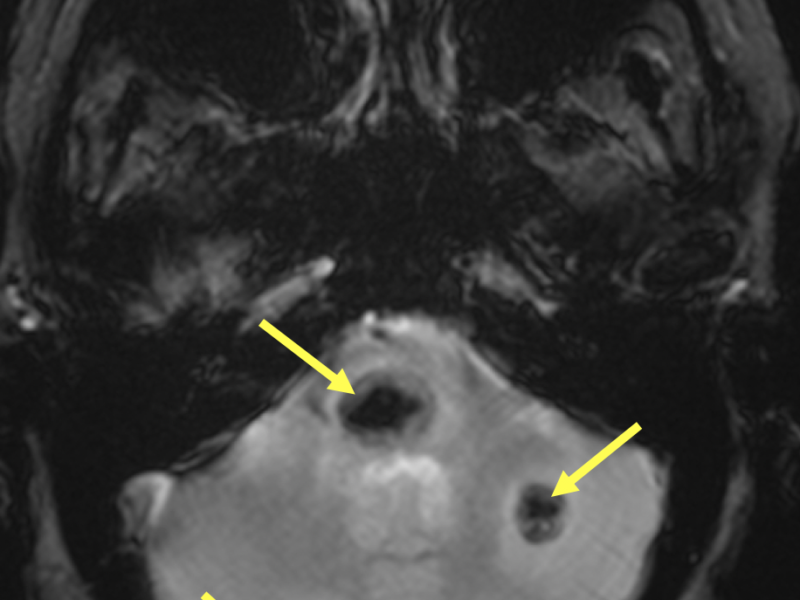 C. Axial gradient echo (GRE) image at the same level as (B) better shows the low signal blooming artifact (arrows) in the pons and cerebellar lesions.