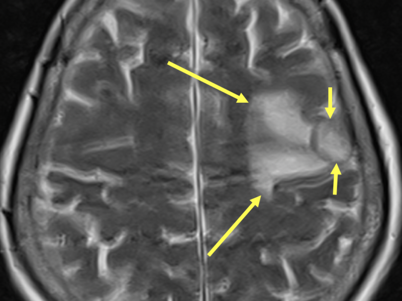 E. Axial T2 image at the same level as (D) shows a 1.6 cm high signal left frontal lobe lesion (short arrows), and surrounding high signal vasogenic edema (long arrows). There is no blooming artifact and the findings are consistent with a non-hemorrhagic metastasis.