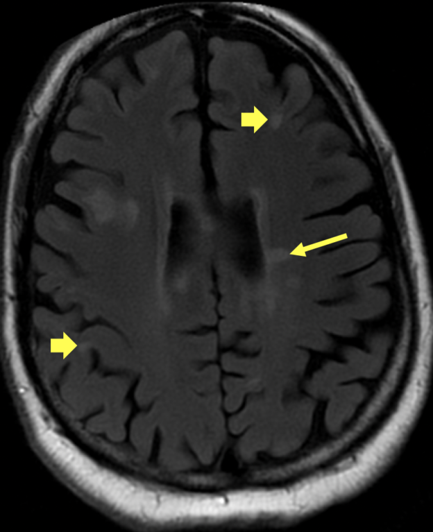 Multiple sclerosis in a 50-year-old man.   Axial T2-weighted FLAIR image shows multiple hyperintense, ovoid, fairly well-demarcated white matter lesions in a subcortical (short arrows) and periventricular (long arrow) location.  Many of the lesions were new compared with a prior MRI, thus meeting the space and time criteria for the diagnosis of MS.