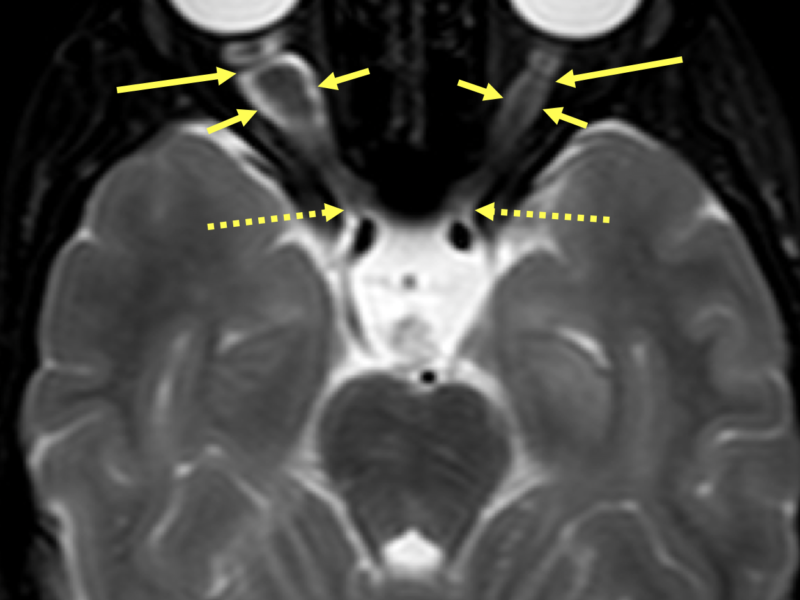 Bilateral optic gliomas in an 8-year-old girl with NF1 and café au lait spots. A. Axial T2 SPIR MRI shows fusiform enlargement of the optic nerves (short solid arrows) with kinking and buckling (long solid arrows), right greater than left. The optic canals (dashed arrows) are normal.   