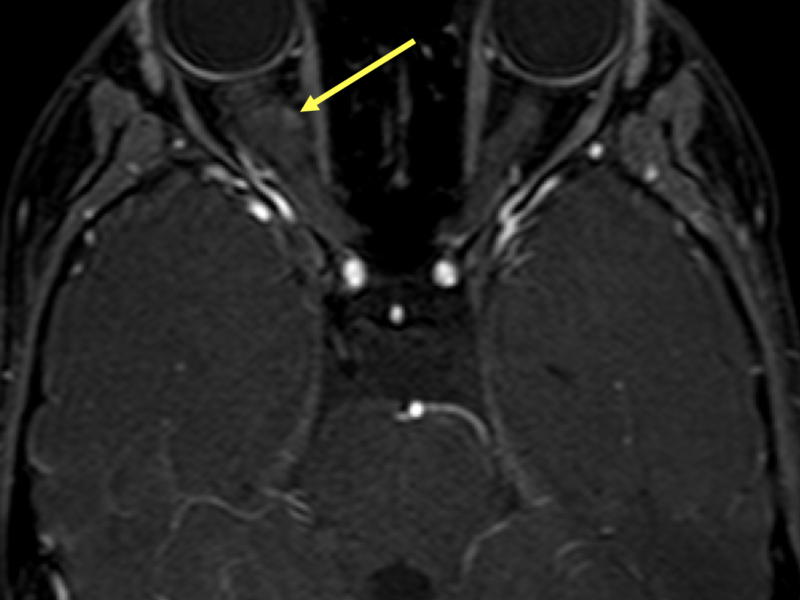 B. Axial T1 3D SPIR (fat saturation) image post contrast shows a small area of enhancement along the superomedial margin of the right optic glioma (arrow).