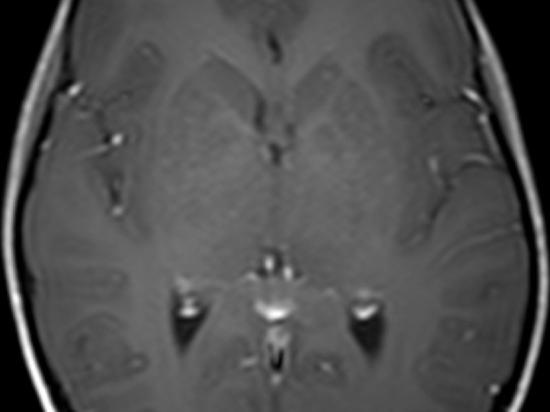 F. Axial T2 SE post contrast image at the same level as (E) shows no enhancement of the basal ganglia lesions.
