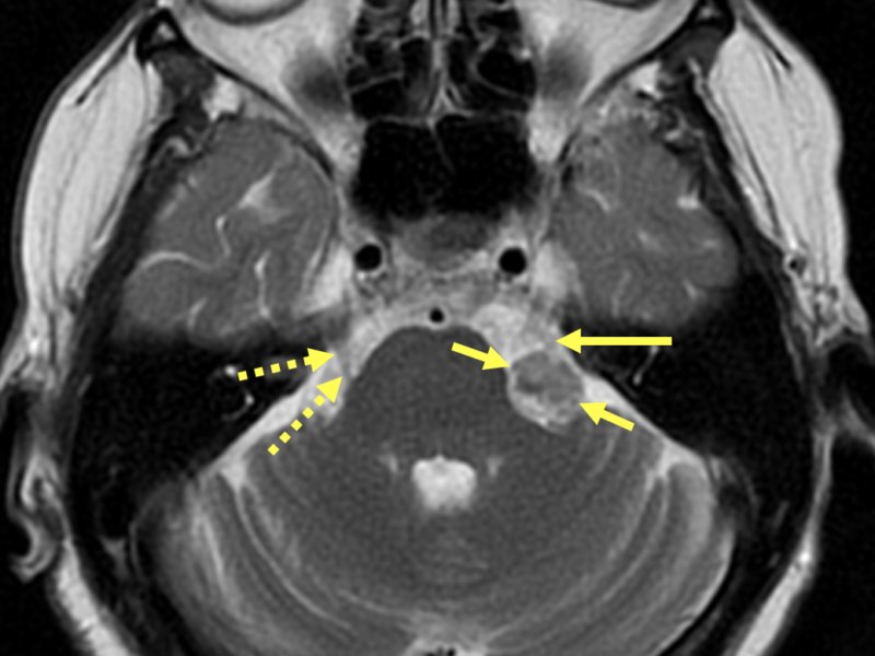 D. Axial T2 with contrast at a level superior to (A) shows anterior displacement of the left trigeminal (5th) nerve (long solid arrow), shown in cross-section, by the CPA mass (short solid arrows). The normal right 5th nerve as it courses anteriorly is shown in profile (dashed arrows).